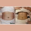 Fat Freeze 10 Sessions Package (MEDIA)