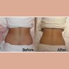 Fat Freeze 10 Sessions Package (MEDIA)