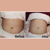 Fat Freeze 10 Sessions Package (MEDIA)
