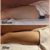 Fat Freeze 10 Sessions Package (MEDIA)