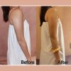Fat Freeze 10 Sessions Package (MEDIA)