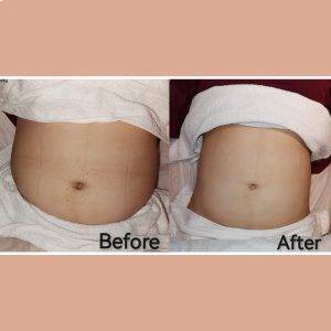 Fat Freeze Trial (3 Sessions) + Consultation Fat Freeze Trial (3 Sessions) + Consultation