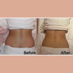 Fat Freeze Trial (3 Sessions) + Consultation Fat Freeze Trial (3 Sessions) + Consultation