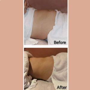 Fat Freeze Trial (3 Sessions) + Consultation Fat Freeze Trial (3 Sessions) + Consultation
