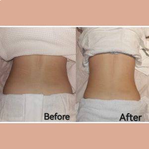 Fat Freeze Trial (3 Sessions) + Consultation Fat Freeze Trial (3 Sessions) + Consultation