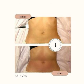 Image 18: Remarkable Results Achieved in Just One Session of RET RF Lipolysis! Our client, who has a slim physique, desired additional fat reduction in the abdominal area. Following a single session, significant improvements were observed: enhanced grooves and contours on the tummy, along with a more defined waistline. PM us for trial prices.